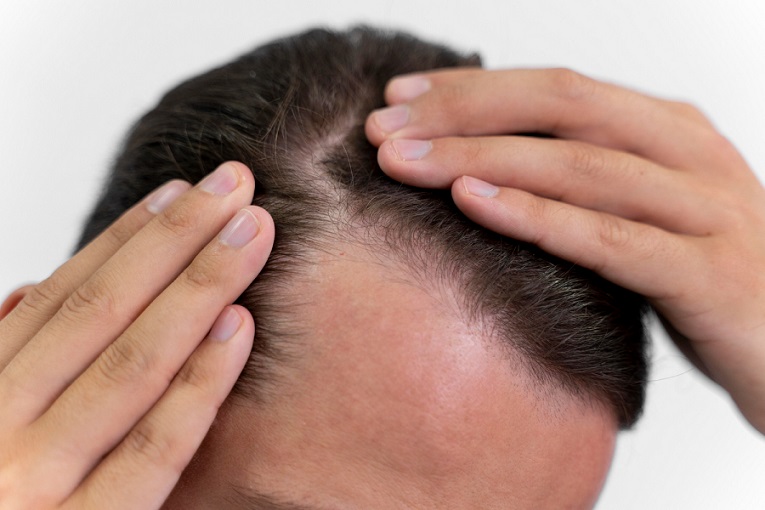 Minoxidil para o cabelo